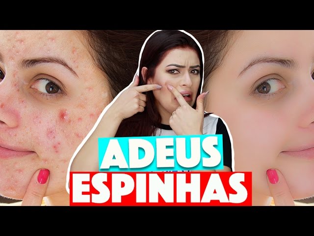 Como acabar com acnes em instantes